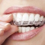 teeth with whitening tray