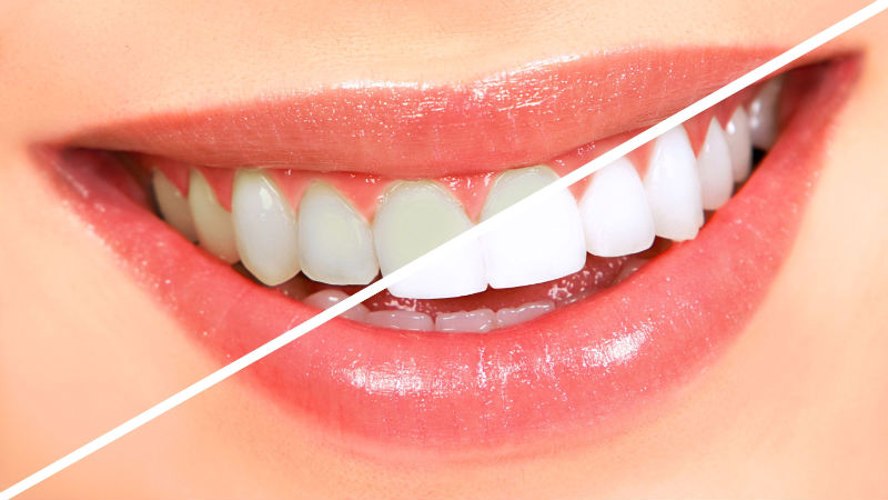 Your Teeth Can Be Whiter Than Ever Through Cosmetic Dentistry in St George UT