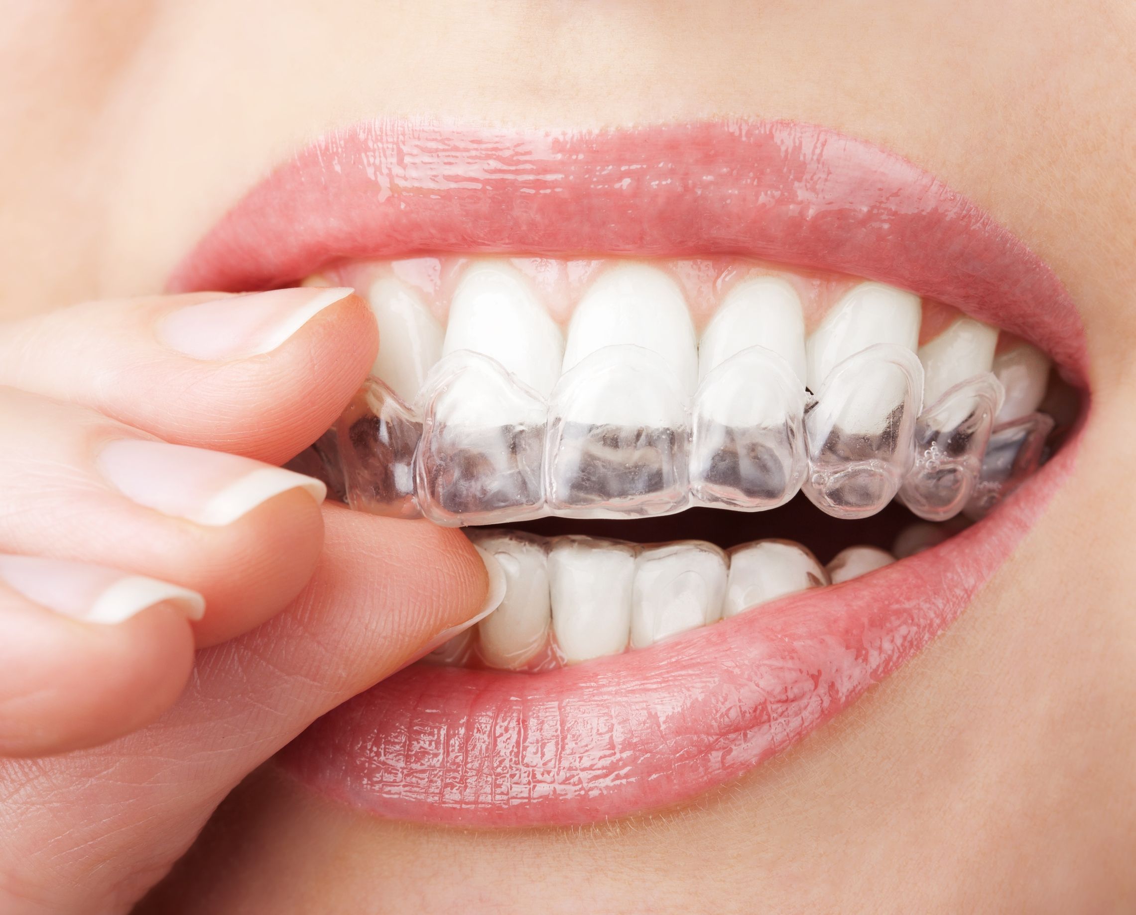 Straighten Your Teeth With Invisalign In Bayside, NY