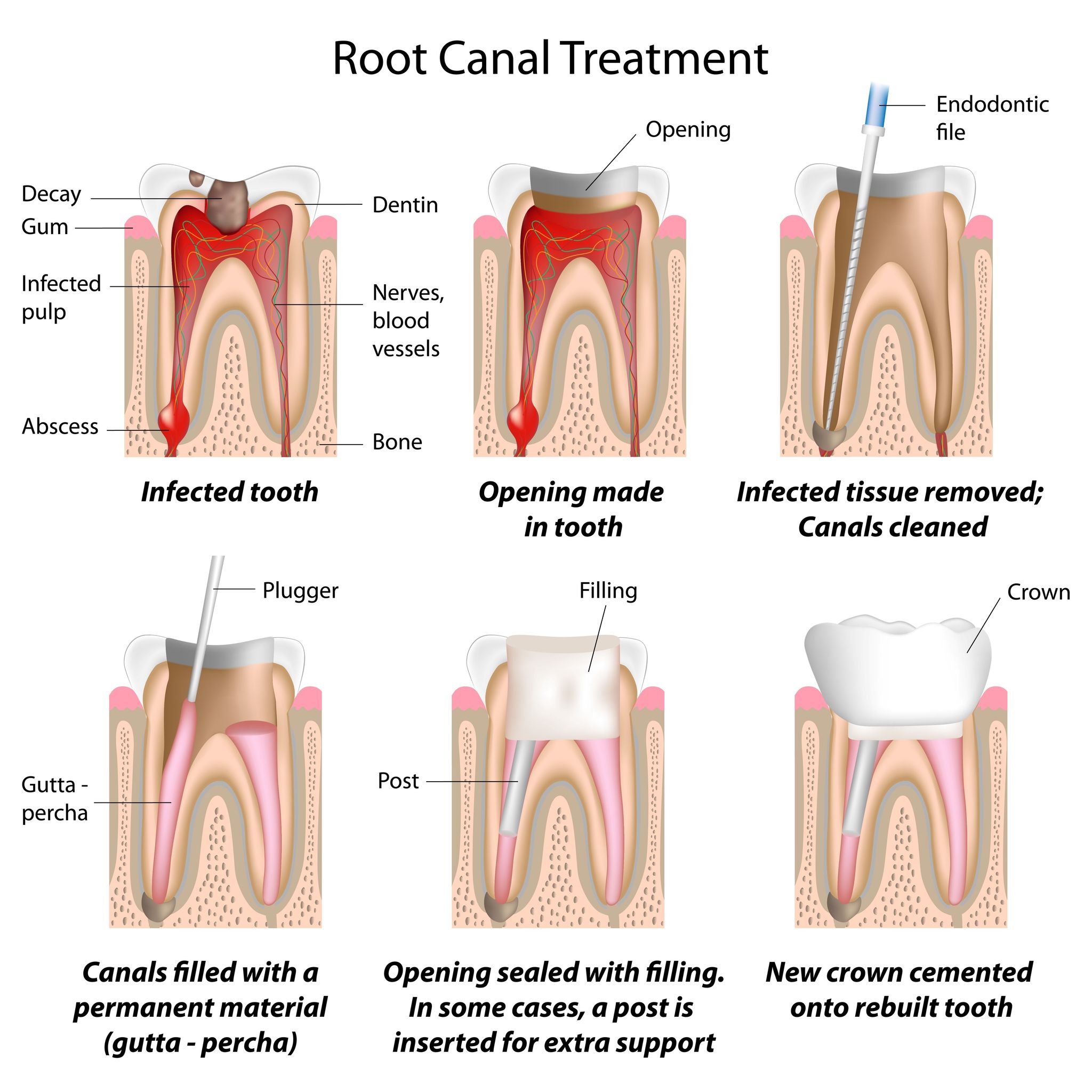 Dentists in Vista, CA Explain Why Root Canals Relieve Tooth Pain