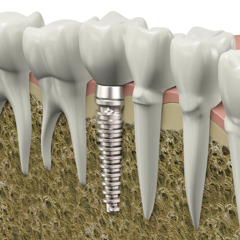 Get Your Old Smile Back with Dental Implants in DC