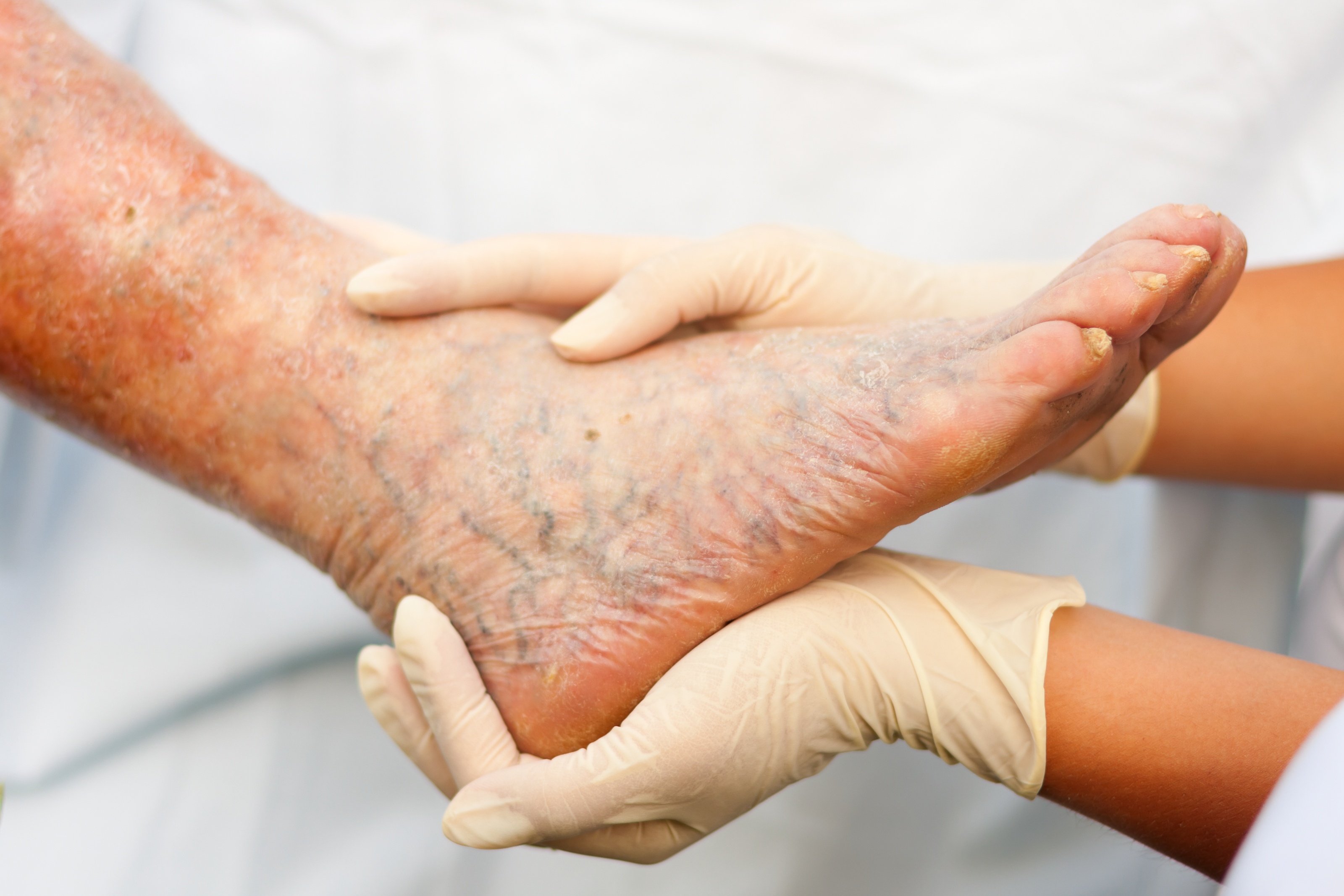 Is sclerotherapy for varicose veins right for you?