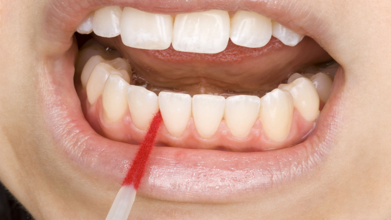 Teeth Whitening In Castle Hill: Advantages