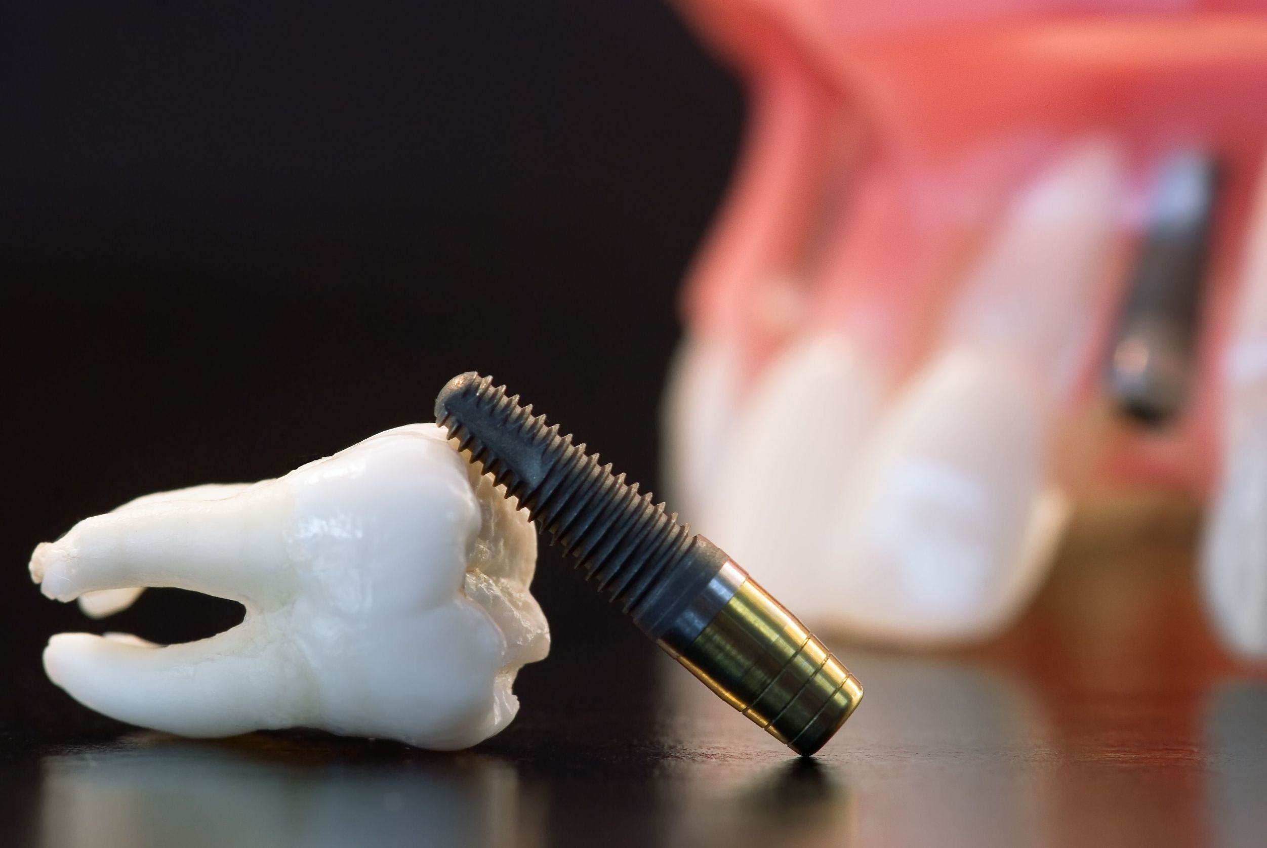 Dental Implants and Restoration Dentistry